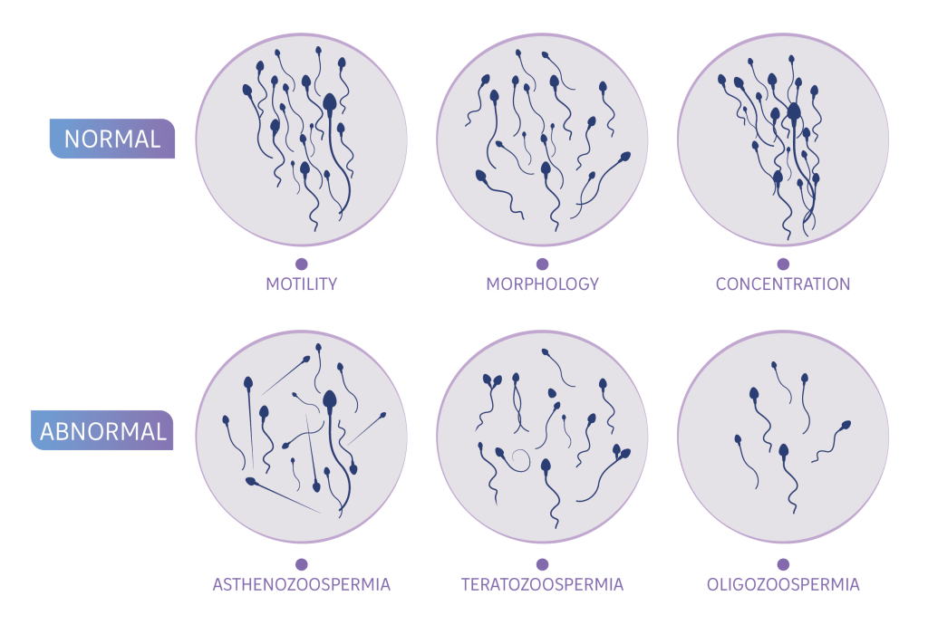 Graphic_illustration_of the_microscopic_view_of_sperm_conditions_that_cause_infertility